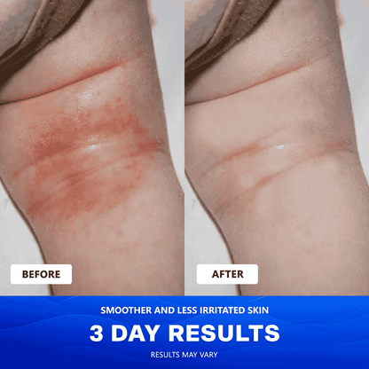 Uvora Eczema-Relief Ocean Blend