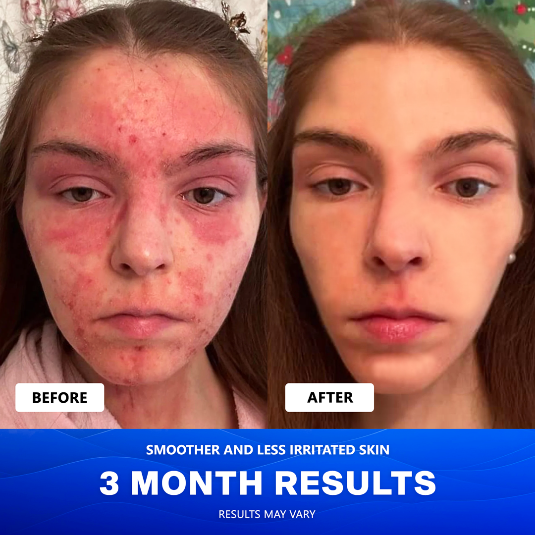 Uvora Eczema-Relief Ocean Blend