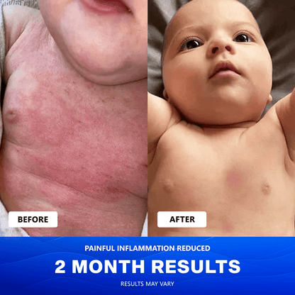Uvora Eczema-Relief Ocean Blend