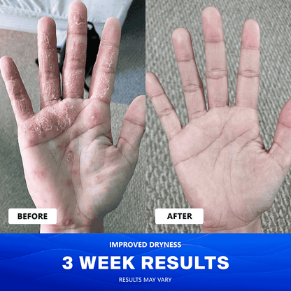 Uvora Eczema-Relief Ocean Blend